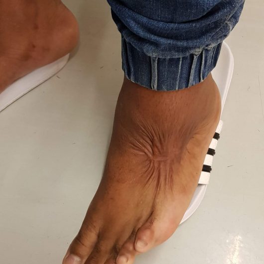 burns contracture on foot 